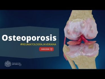 Osteoporosis