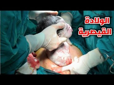 شاهد الولادة القيصرية من البداية لنهاية cesarean section