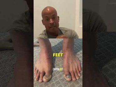 David Goggins&39; FEET After 23 YEARS Of RUNNING😳