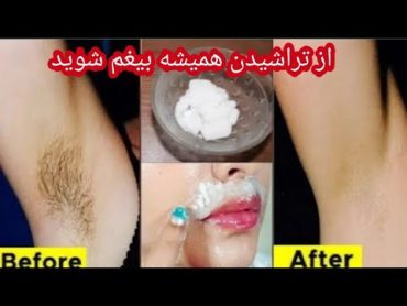 بهترین و آسانترین  روش از بین بردن موهای زاید برای همیشه