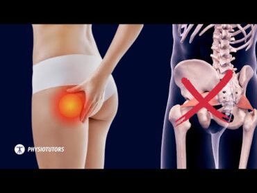 Pain in the butt  It&39;s NOT Piriformis Syndrome