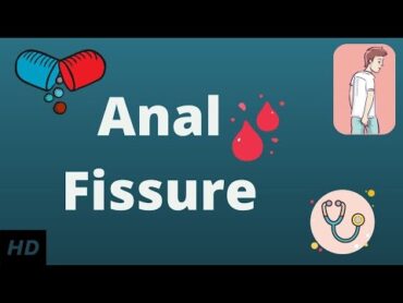 ANAL FISSURE? Causes, Signs and Symptoms, Diagnosis and Treatment