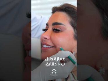 غمازة خد ب ١٠ دقائق..غمازة فيلر  الكويت الكويتيات كويتيات تجميل kuwait  بوتكس dimples