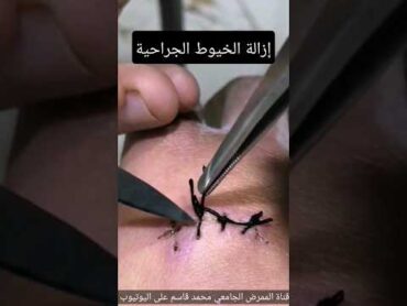 كيفية ازالة الخيوط الجراحية(الغرز الجراحية)  How to Remove Surgical Sutures shorts محمد قاسم