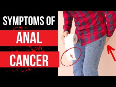 Doctor explains SYMPTOMS OF ANAL CANCER  plus risk factors, diagnosis and treatment