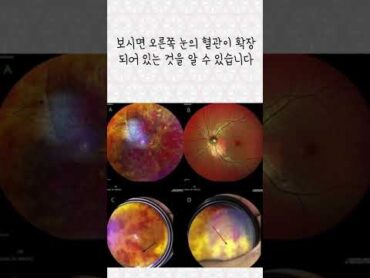 비아그라 정량 이상 먹은 30대 남성 시력 상실이 초래되었습니다