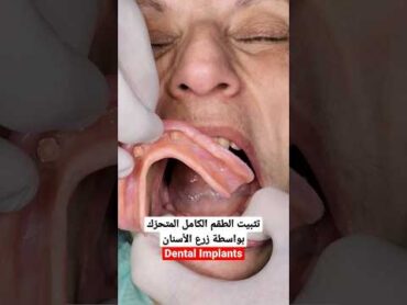 زرع الأسنان لتثبيت الطقم المتحرّك shorts fyp dentist