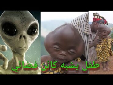 سبحان الله طفل يشبه كائن فضاء 😲😢ربي يشفيه