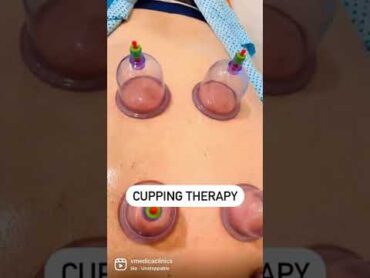 Cupping Therapy/ Hijama Therapy.