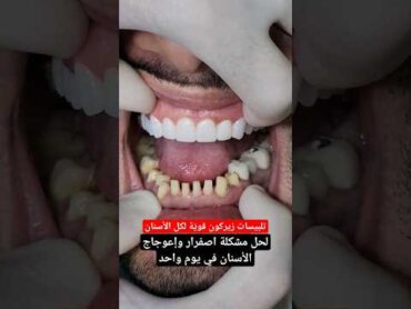 تلبيس اسنان زيركون في يوم واحد